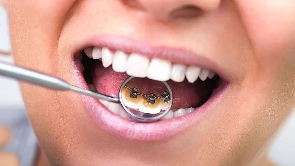 During a dental exam at Smile Orthodontics in Leominster or Gardner, MA, a mirror shows lingual braces on the back of teeth, highlighting discreet alternatives to traditional braces.