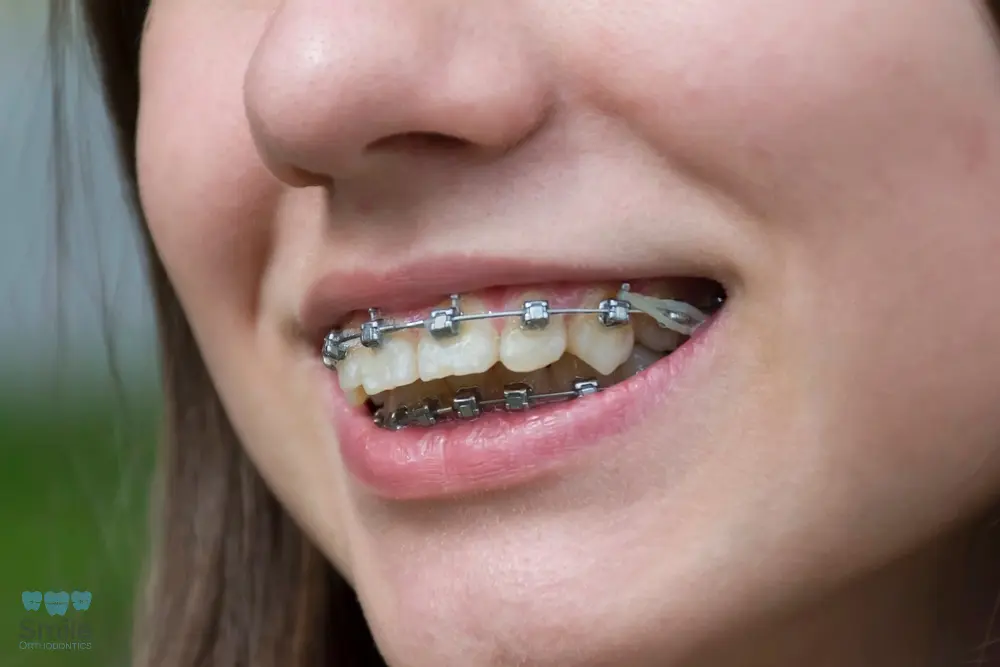 Orthodontist examining a young woman with braces during a dental checkup – Braces for Overbite in Leominster and Gardner, MA