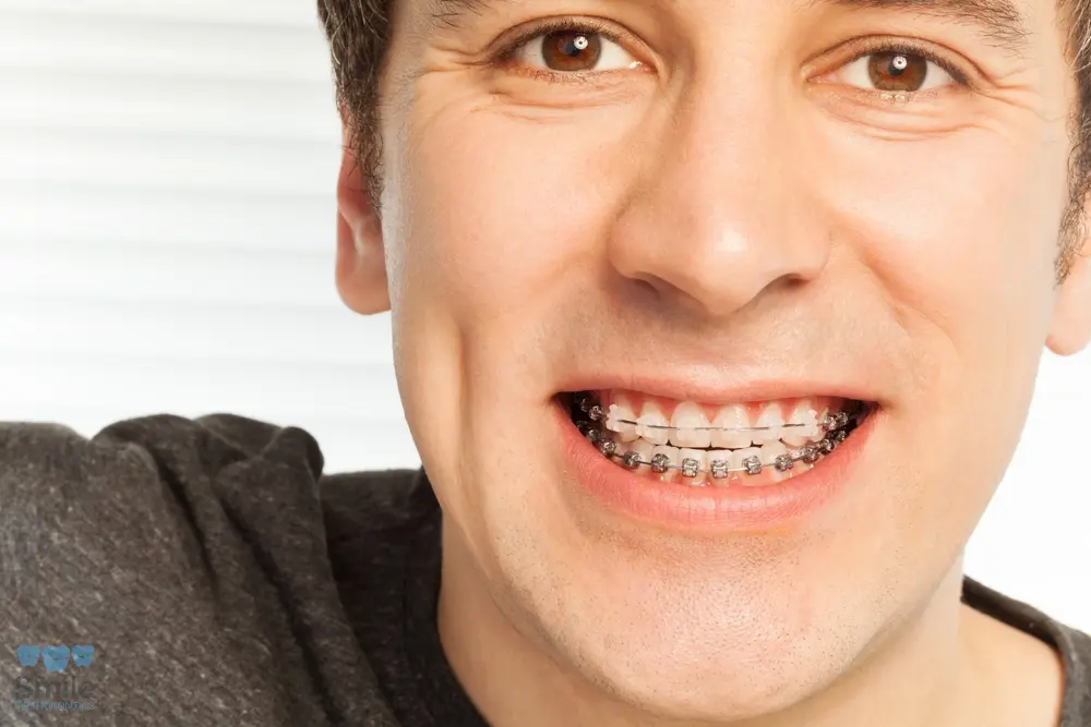 happy young man with metal braces - Overbite vs Underbite in Leominster and Gardner, MA.