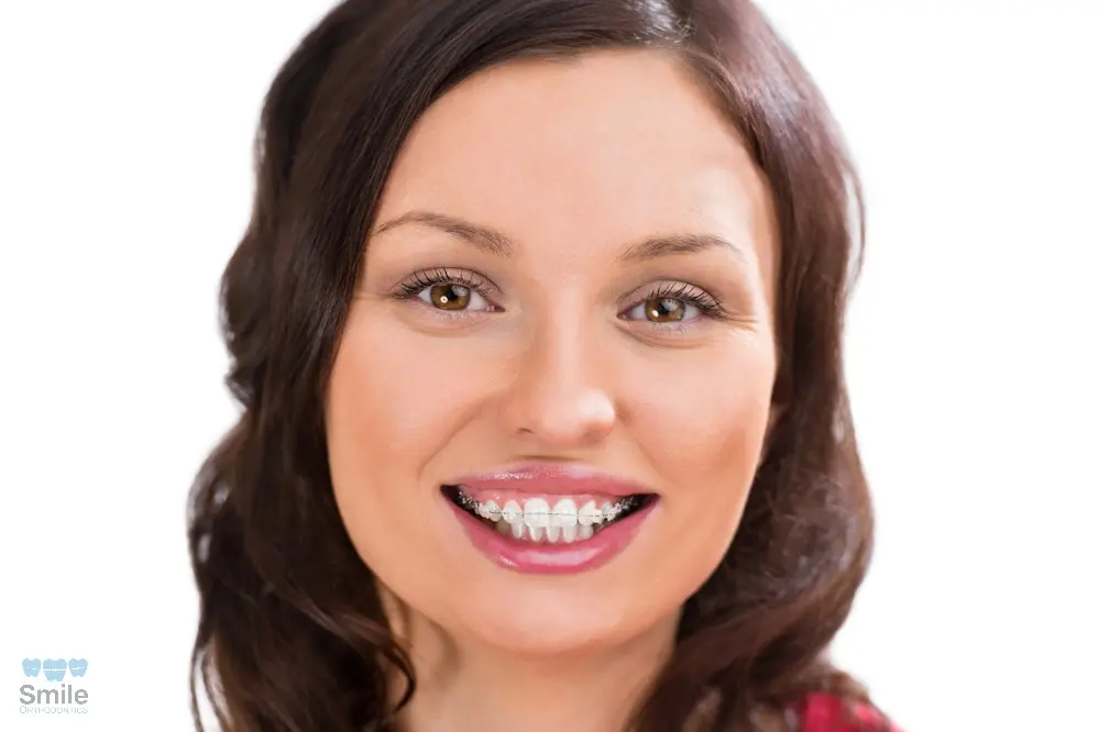 woman wearing orthodontic ceramic clear braces - Overbite vs Underbite in Leominster and Gardner, MA.