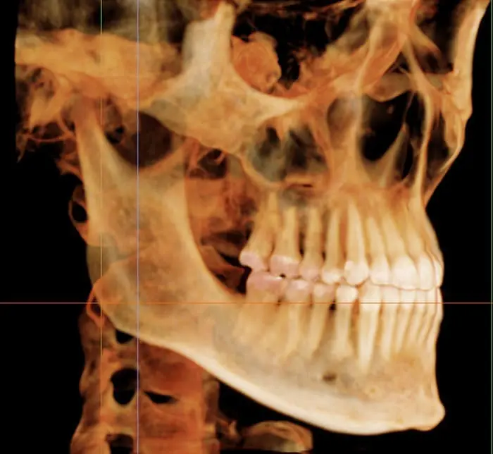 A 3D dental X-ray displays the side view of a skull, jaw, and teeth alignment at Smile Orthodontics in Gardner, MA.